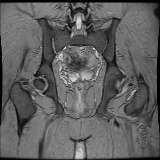 Avascular necrosis of the hip (Radiopaedia 61503-69465 F 68).jpg
