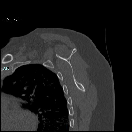 File:Avascular necrosis of the shoulder - Cruess stage I (Radiopaedia 77674-89887 Sagittal bone window 2).jpg