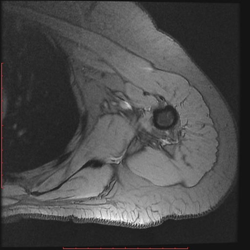 File:Avulsion fracture - greater tuberosity of humerus (Radiopaedia 25457-25703 Axial Gradient Echo 17).jpg