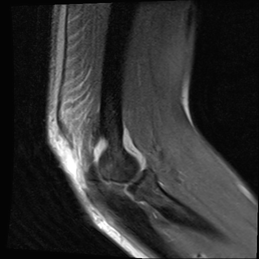 File:Avulsion of the triceps tendon (Radiopaedia 42919-46154 Sagittal PD fat sat 1).jpg