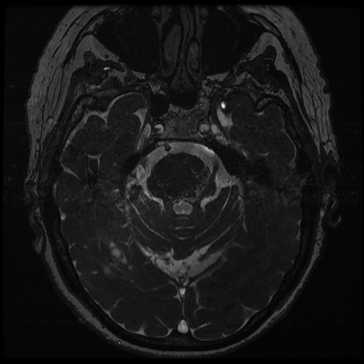 File:Balo concentric sclerosis (Radiopaedia 53875-59982 Axial T2 FIESTA 56).jpg