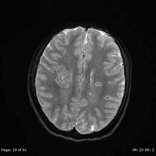 File:Balo concentric sclerosis (Radiopaedia 61637-69636 Axial DWI 19).jpg