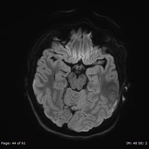 Balo concentric sclerosis (Radiopaedia 61637-69636 Axial DWI 44).jpg
