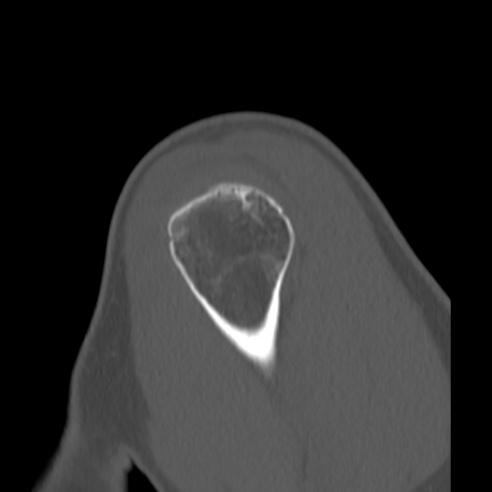 Bankart lesion (Radiopaedia 57256-64185 Sagittal bone window 9).jpg