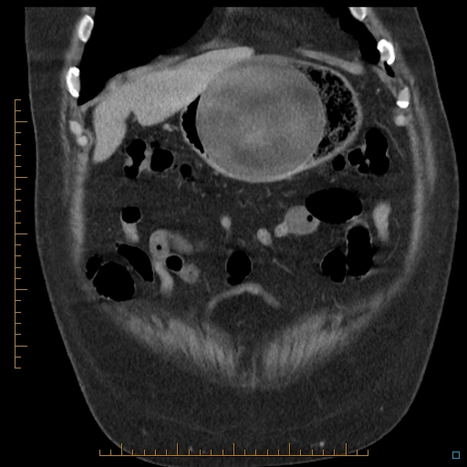 File:Bariatric balloon causing gastric outlet obstruction (Radiopaedia 54449-60672 B 10).jpg