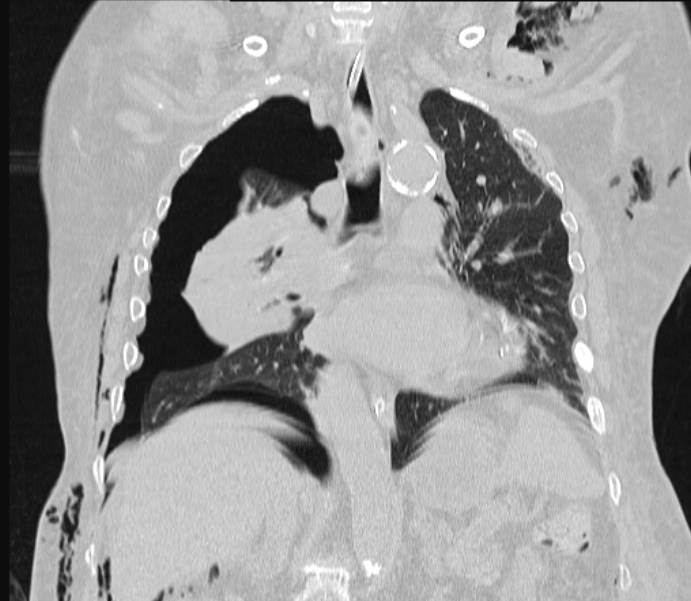 Barotrauma due to mechanical ventilation (Radiopaedia 28079-28336 Coronal lung window 54).jpg
