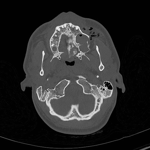 Base of skull fracture with bilateral Le Fort fractures (Radiopaedia 47094-51638 Axial bone window 18).jpg