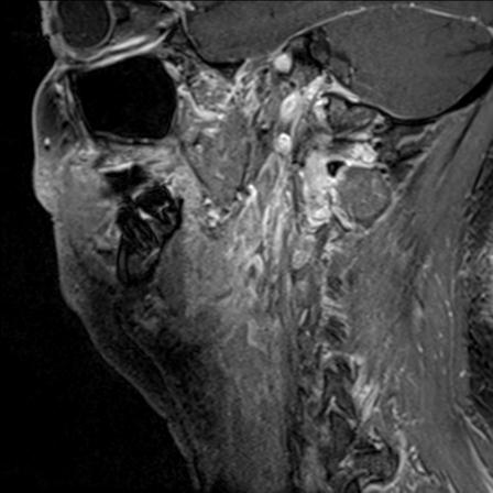 Base of tongue squamous cell carcinoma (Radiopaedia 31174-31884 F 55).jpg