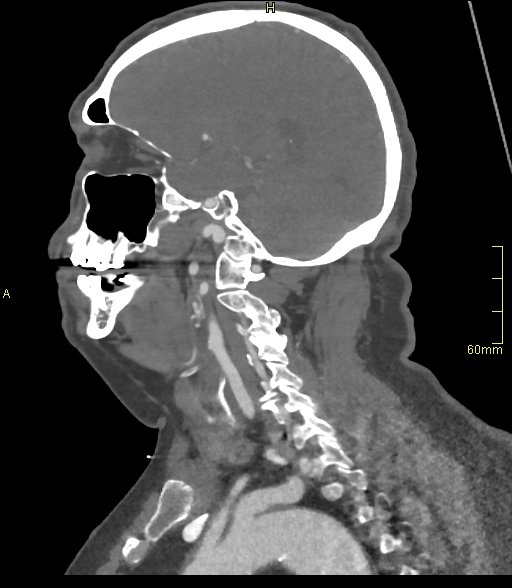 Basilar artery aneurysm (Radiopaedia 56261-62932 C 44).jpg