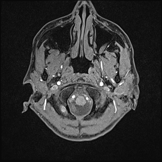 File:Basilar artery perforator aneurysm (Radiopaedia 82455-97733 Axial T1 fat sat 3).jpg