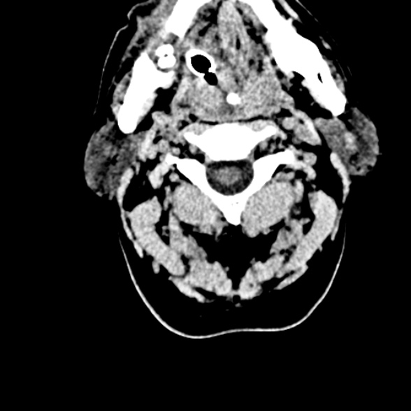 File:Basilar artery thrombosis (Radiopaedia 53351-59352 Axial non-contrast 2).jpg