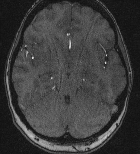 Basilar tip aneurysm (Radiopaedia 26504-26632 MRA 91).jpg