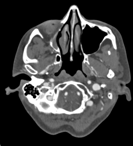 File:Basilar tip aneurysm with coiling (Radiopaedia 53912-60086 A 21).jpg