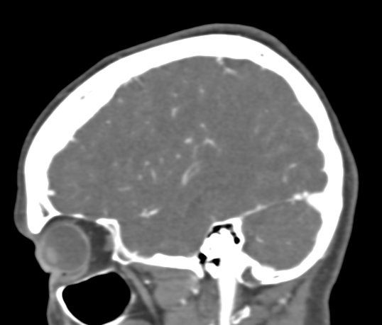 Basilar tip aneurysm with coiling (Radiopaedia 53912-60086 C 29).jpg