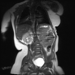 File:Beckwith-Wiedeman syndrome with bilateral Wilms tumors (Radiopaedia 60850-69233 B 11).jpg