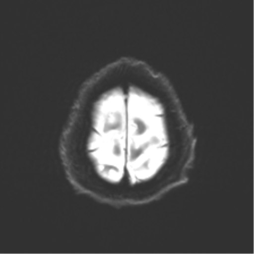 Behavioral variant frontotemporal dementia and late onset schizophrenia (Radiopaedia 52197-58083 Axial DTI Trace W 25).png