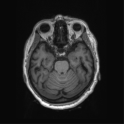 Behavioral variant frontotemporal dementia and late onset schizophrenia (Radiopaedia 52197-58083 Axial T1 73).png