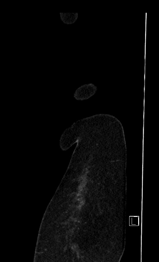 Below filter IVC thrombosis (Radiopaedia 58187-65266 C 17).jpg