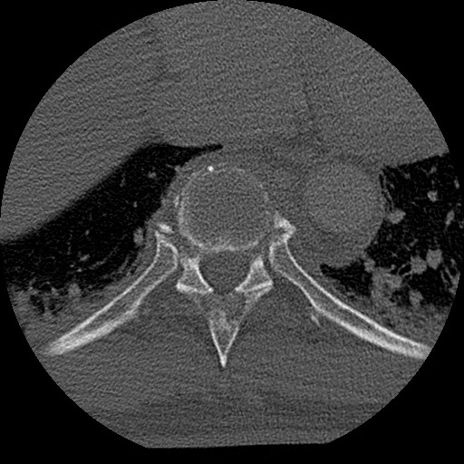 Benign post-traumatic pseudopneumoperitoneum (Radiopaedia 71199-81495 Axial bone window 128).jpg