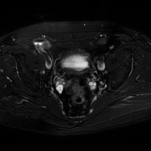 File:Benign prostatic nodular hyperplasia (Radiopaedia 16917-16634 Axial T2 fat sat 3).jpg