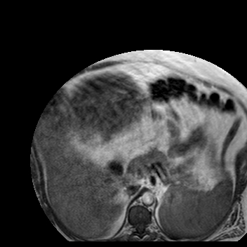 File:Benign seromucinous cystadenoma of the ovary (Radiopaedia 71065-81300 Axial T1 35).jpg