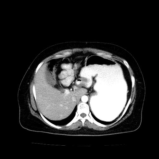 Benign spindle cell tumor - abdominopelvic (Radiopaedia 61300-69212 A 13).jpg