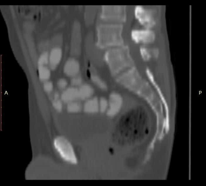 Bertolotti syndrome (Radiopaedia 58974-66235 Sagittal bone window 26).jpg