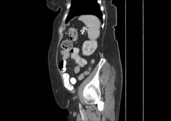 Bicameral celiacomesenteric aneurysm (Radiopaedia 55766-62327 B 44).jpg