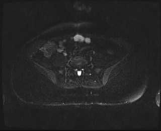 File:Bicornuate bicollis uterus (Radiopaedia 61626-69616 Axial PD fat sat 2).jpg