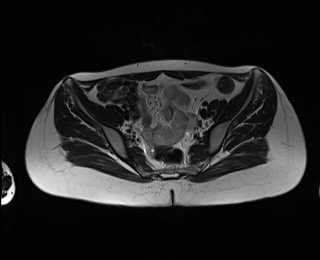 File:Bicornuate bicollis uterus (Radiopaedia 61626-69616 Axial T2 12).jpg
