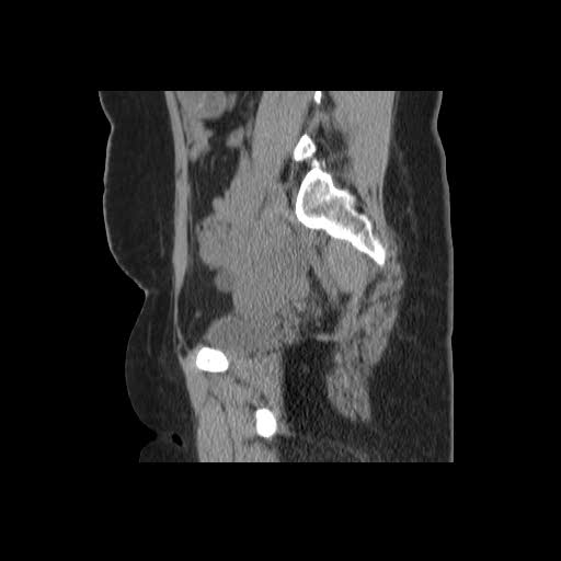 File:Bicornuate uterus- on MRI (Radiopaedia 49206-54296 A 6).jpg