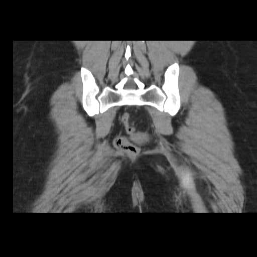 File:Bicornuate uterus- on MRI (Radiopaedia 49206-54296 Coronal non-contrast 19).jpg