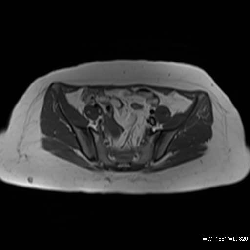 File:Bicornuate uterus- on MRI (Radiopaedia 49206-54297 Axial T1 3).jpg