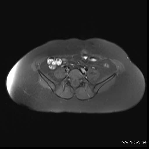 File:Bicornuate uterus- on MRI (Radiopaedia 49206-54297 Axial T1 fat sat 2).jpg