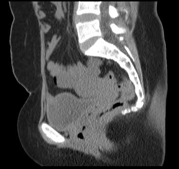 File:Bicornuate uterus (MRI) (Radiopaedia 49206-54296 Sagittal 3).png