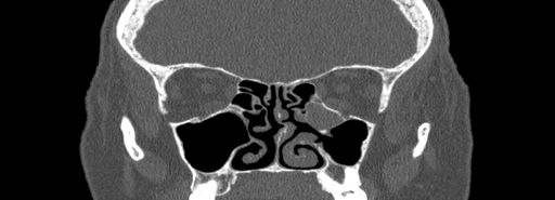 Bilateral Ectopic Infraorbital Nerves (Radiopaedia 49006-54084 Coronal bone window 39).jpg