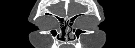 Bilateral Ectopic Infraorbital Nerves (Radiopaedia 49006-54084 Coronal bone window 9).jpg