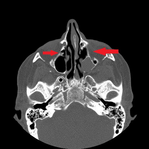 File:Bilateral Ectopic Infraorbital Nerves (Radiopaedia 49006-58325 Axial 6).jpg