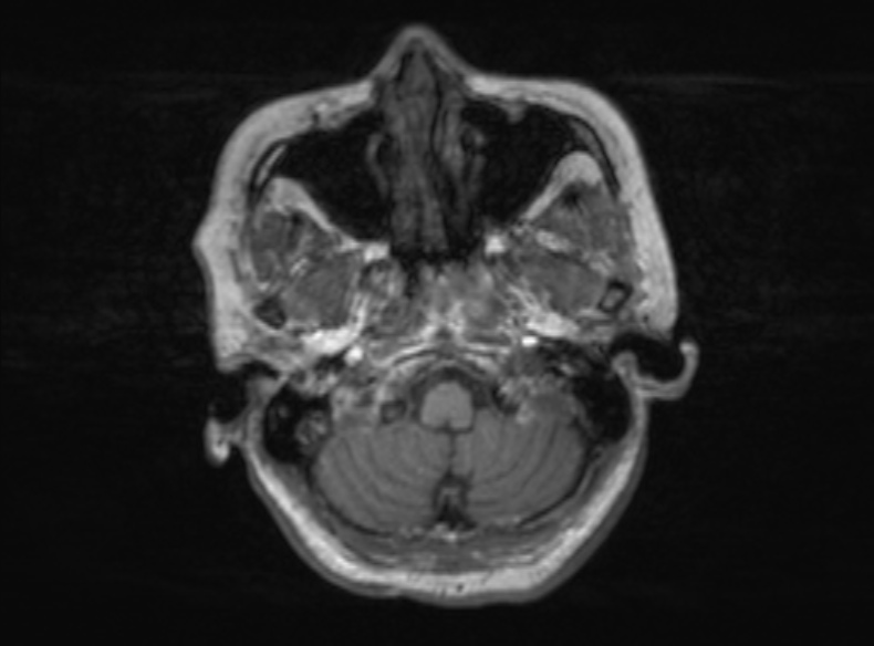Bilateral PCA territory infarction - different ages (Radiopaedia 46200-51784 Axial T1 335).jpg