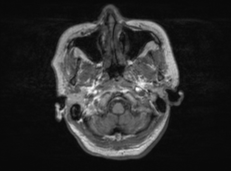 File:Bilateral PCA territory infarction - different ages (Radiopaedia 46200-51784 Axial T1 343).jpg