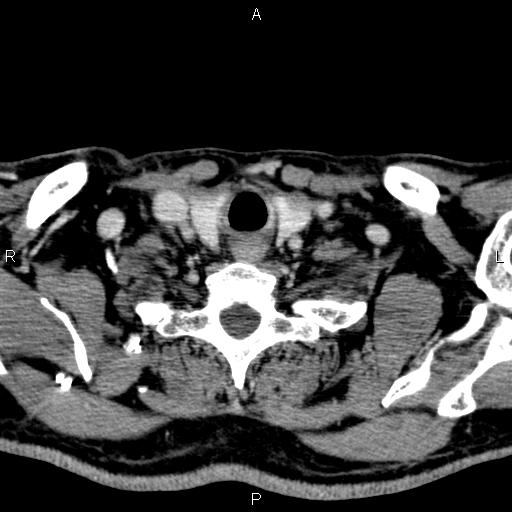 Bilateral Warthin tumors (Radiopaedia 84034-99263 Axial With contrast 57).jpg
