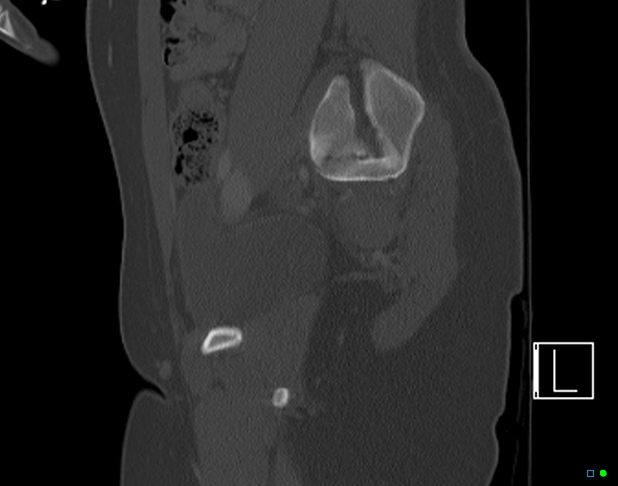 Bilateral acetabular fractures (Radiopaedia 79272-92308 Sagittal bone window 32).jpg