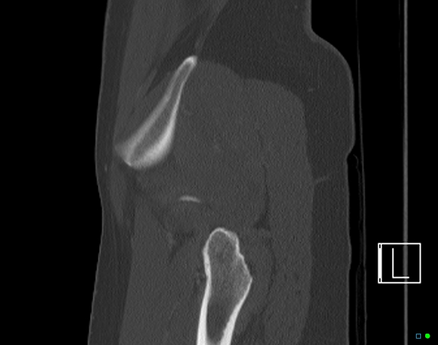 Bilateral acetabular fractures (Radiopaedia 79272-92308 Sagittal bone window 78).jpg