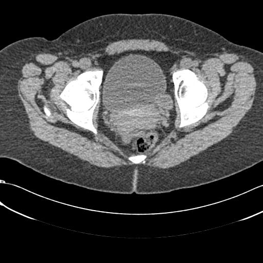 Bilateral acetabular protrusion with pincer type femoro-acetabular impingement (Radiopaedia 30134-30733 AXIAL SOFT THIN 40).jpg