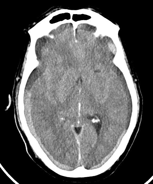 Bilateral acute on chronic subdural hematomas (Radiopaedia 78466-91146 Axial non-contrast 28).jpg