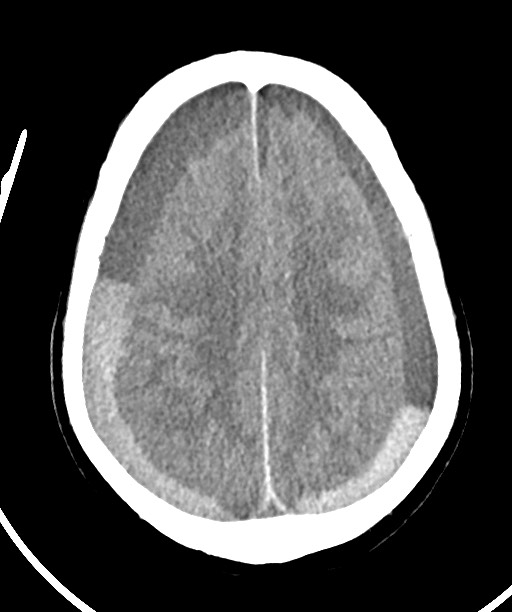 Bilateral acute on chronic subdural hematomas (Radiopaedia 78466-91146 Axial non-contrast 39).jpg