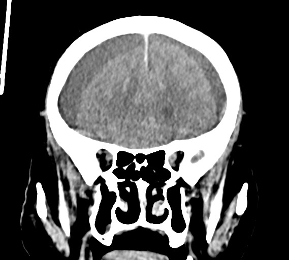 Bilateral acute on chronic subdural hematomas (Radiopaedia 78466-91146 Coronal non-contrast 23).jpg