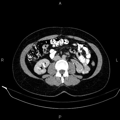 File:Bilateral adrenal myelolipoma (Radiopaedia 63058-71535 Axial C+ delayed 71).jpg