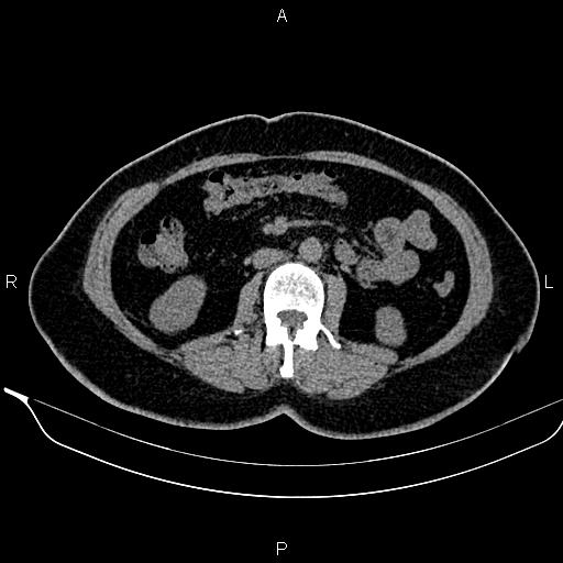 Bilateral benign adrenal adenomas (Radiopaedia 86912-103124 Axial non-contrast 58).jpg