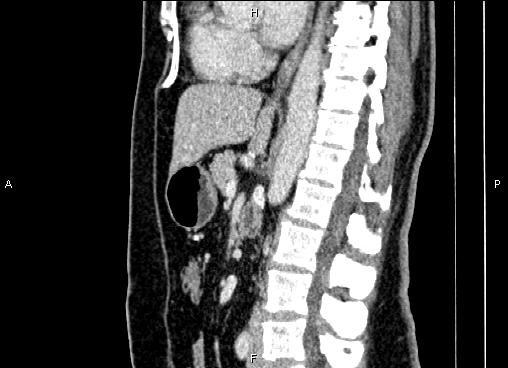 Bilateral benign adrenal adenomas (Radiopaedia 86912-103124 E 51).jpg